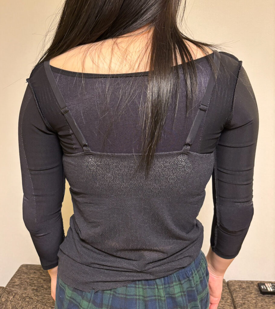 二の腕の脂肪吸引