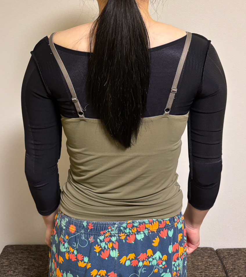 二の腕の脂肪吸引