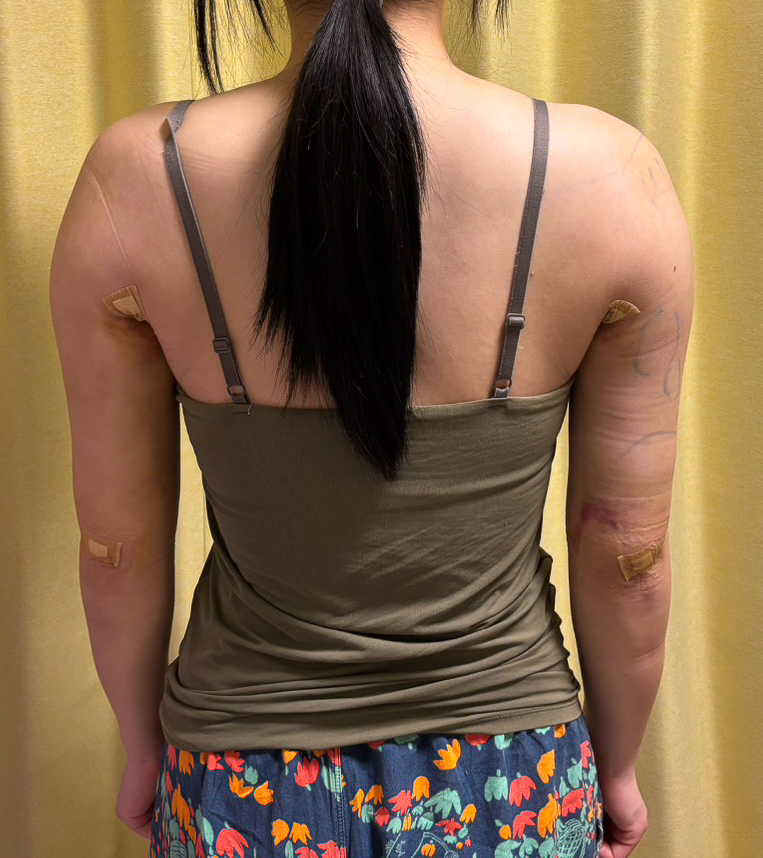 二の腕の脂肪吸引