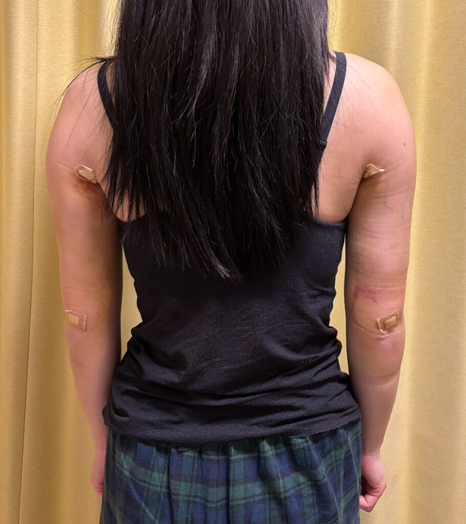 二の腕の脂肪吸引