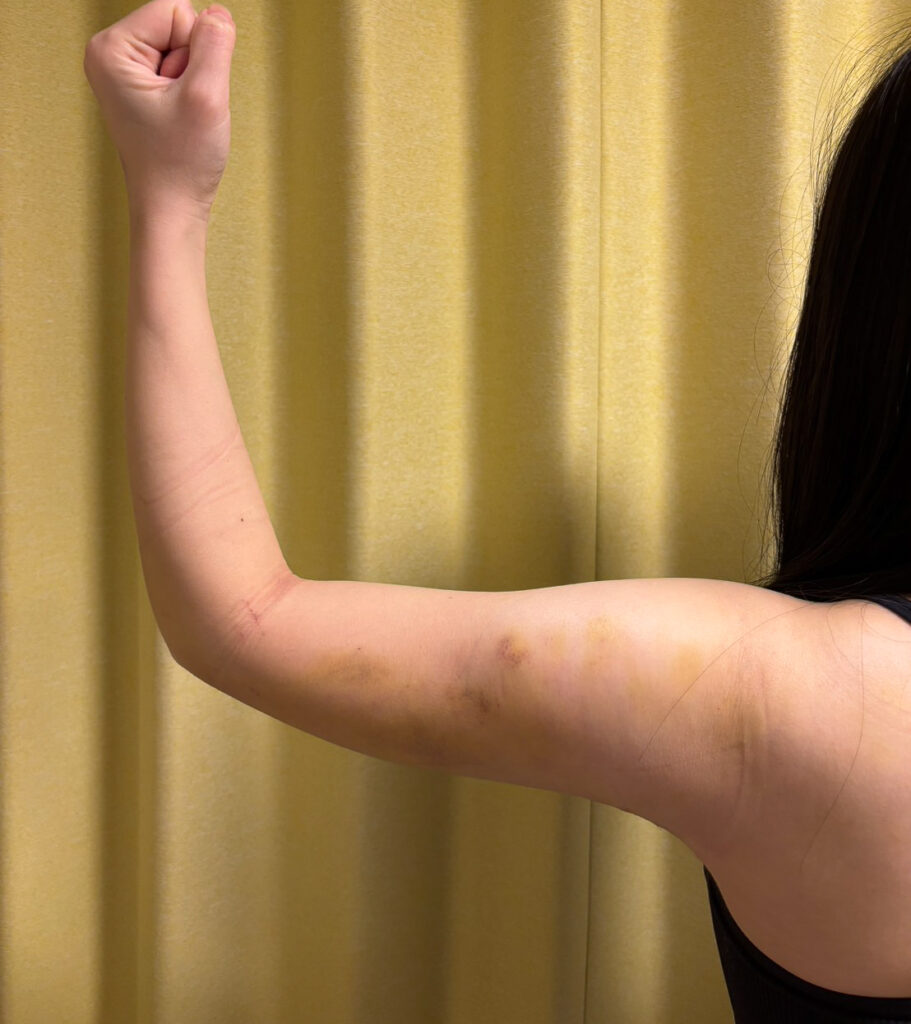 二の腕の脂肪吸引