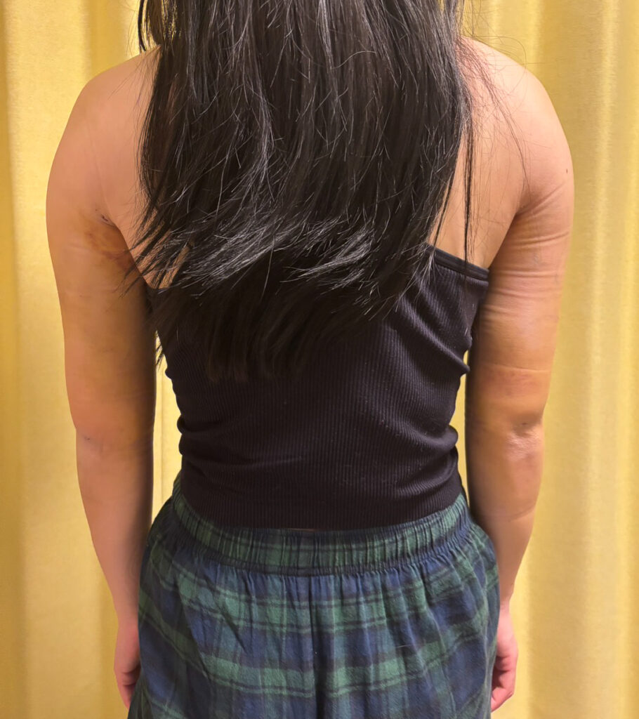 二の腕の脂肪吸引