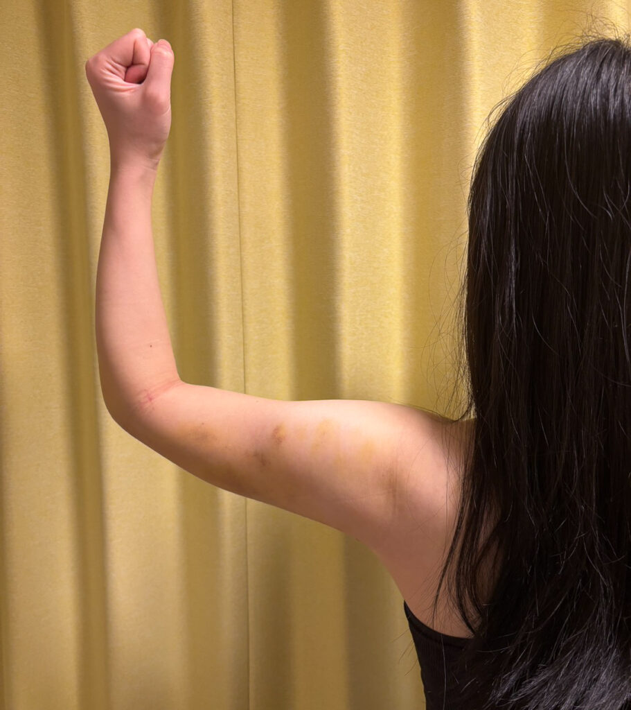 二の腕の脂肪吸引