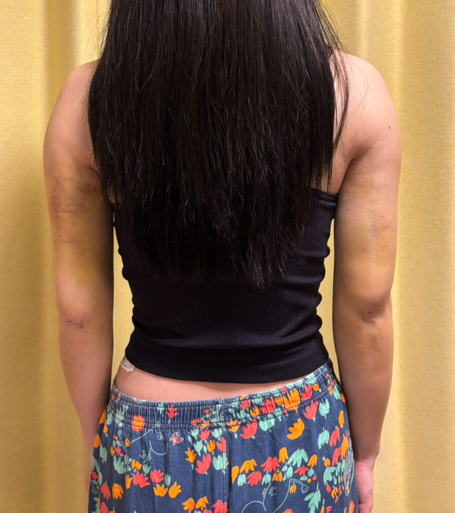 二の腕の脂肪吸引