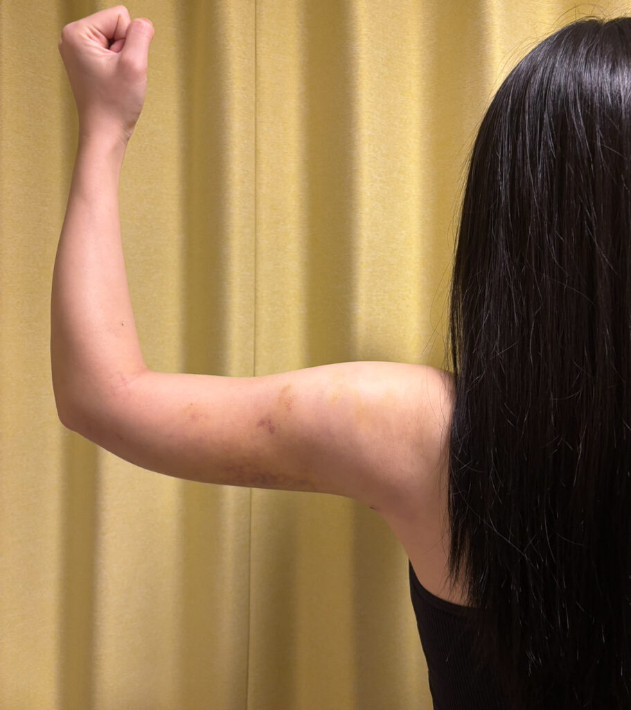 二の腕の脂肪吸引