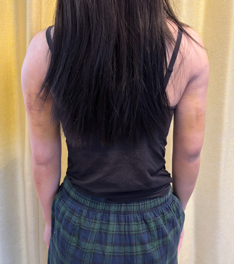 二の腕の脂肪吸引