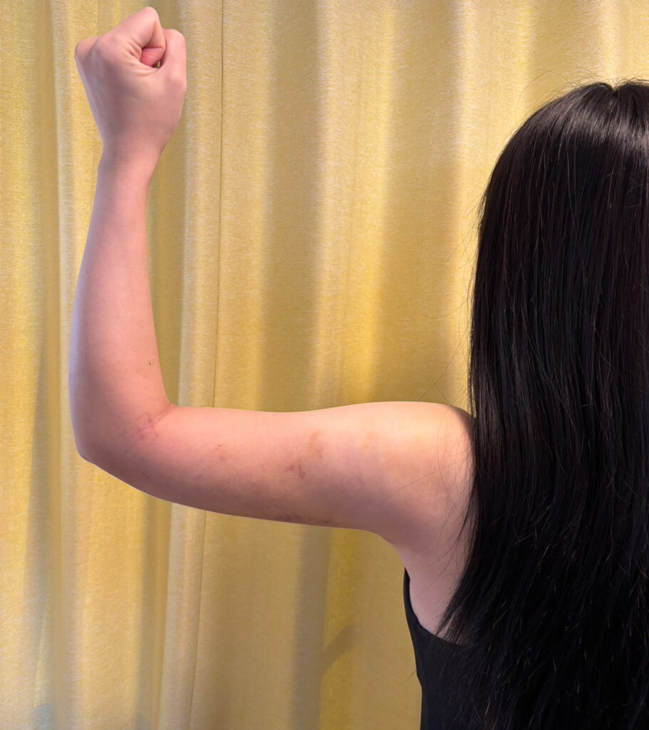 二の腕の脂肪吸引