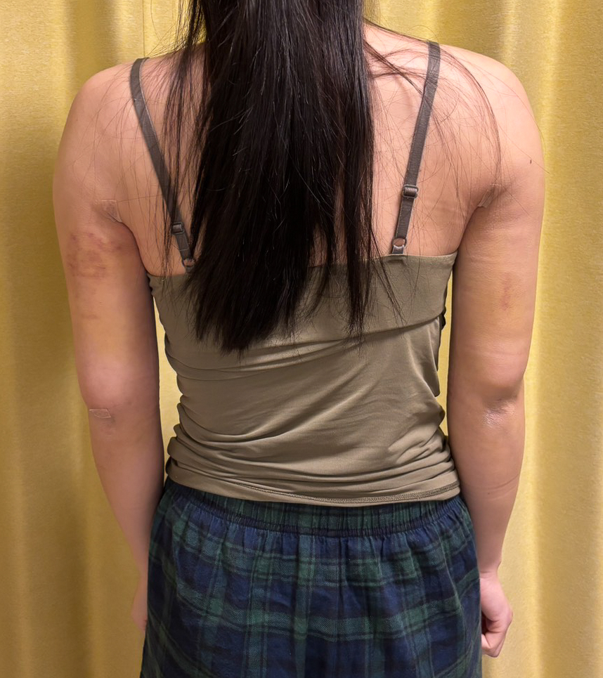 二の腕の脂肪吸引