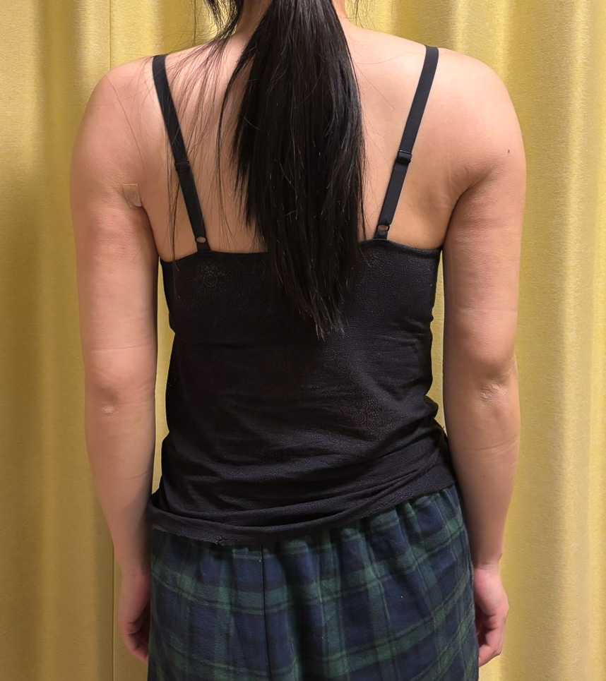 二の腕の脂肪吸引