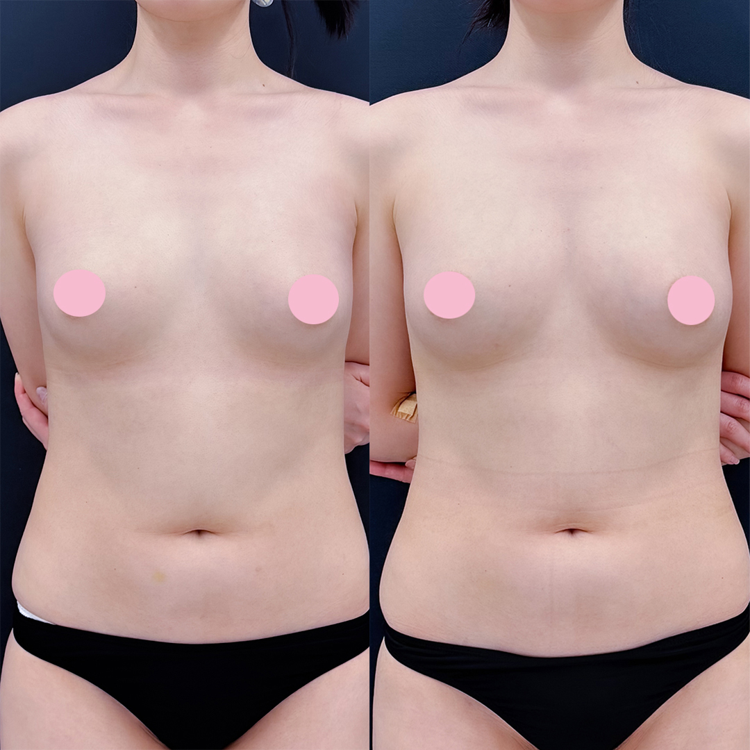 脂肪豊胸