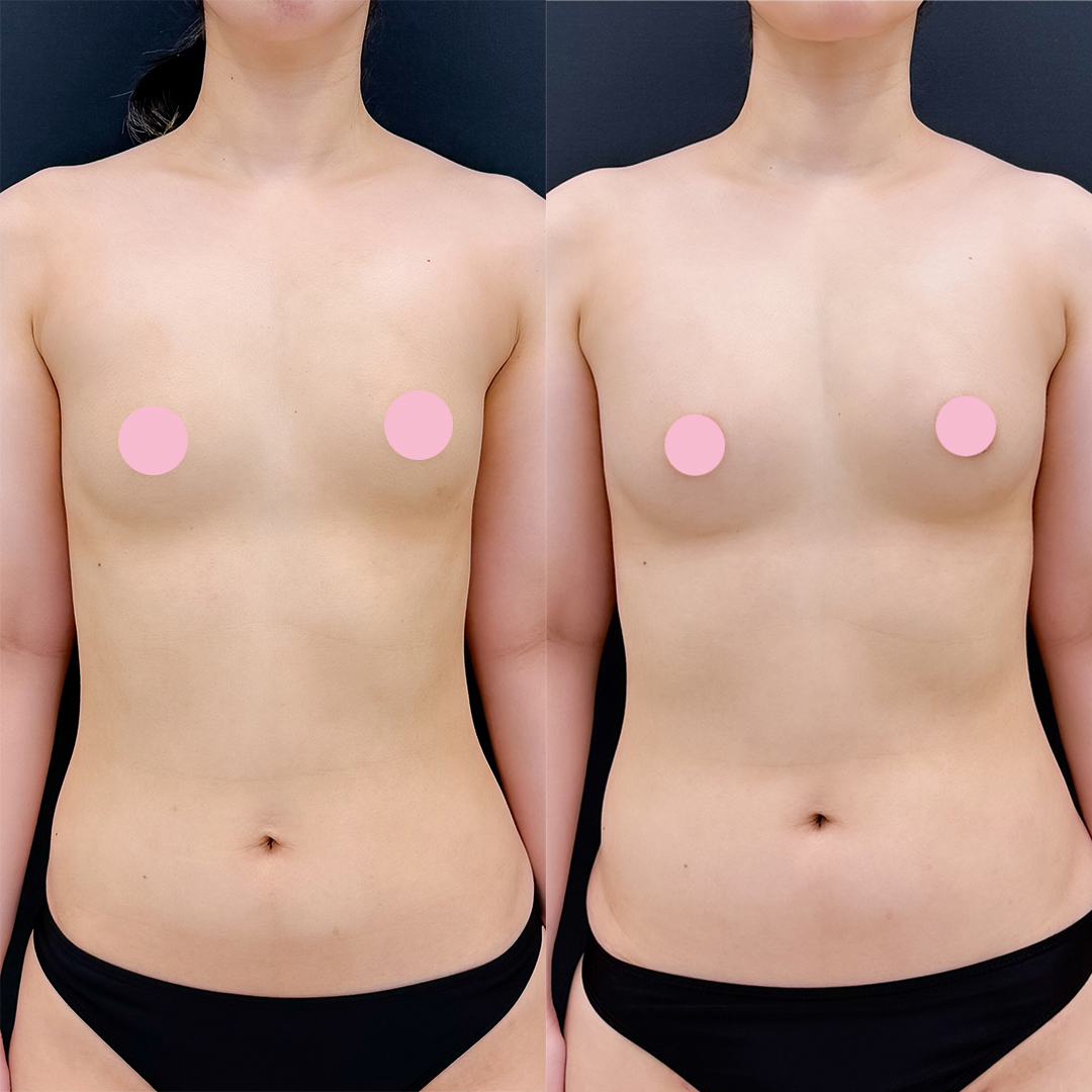 コンデンスリッチ脂肪豊胸