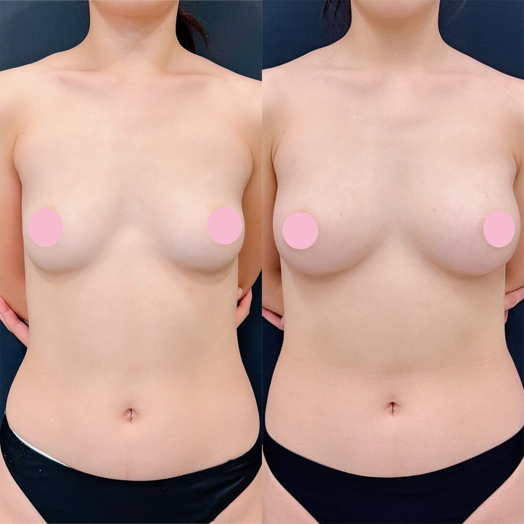 脂肪豊胸