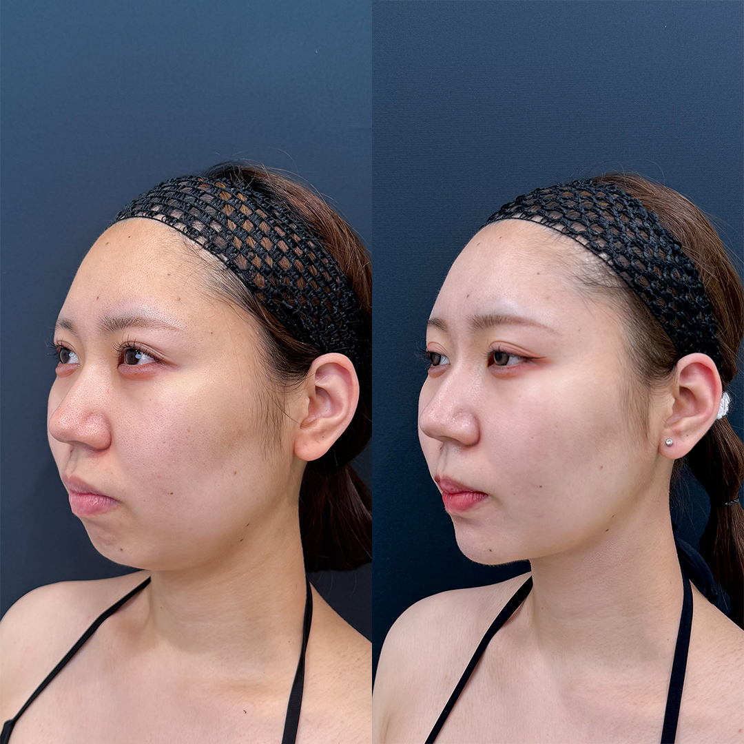 https://purelys-tokyo-clinic.com/wp/wp-content/uploads/2026/03/face-Liposuction_Case-No.453.jpg