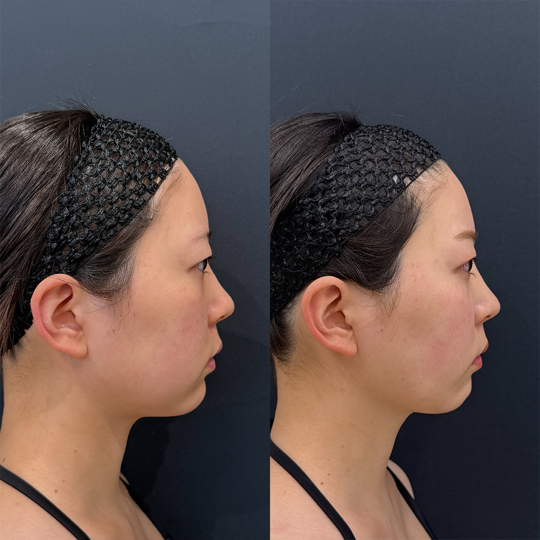 https://purelys-tokyo-clinic.com/wp/wp-content/uploads/2026/03/face-Liposuction_Case-No.481.jpg
