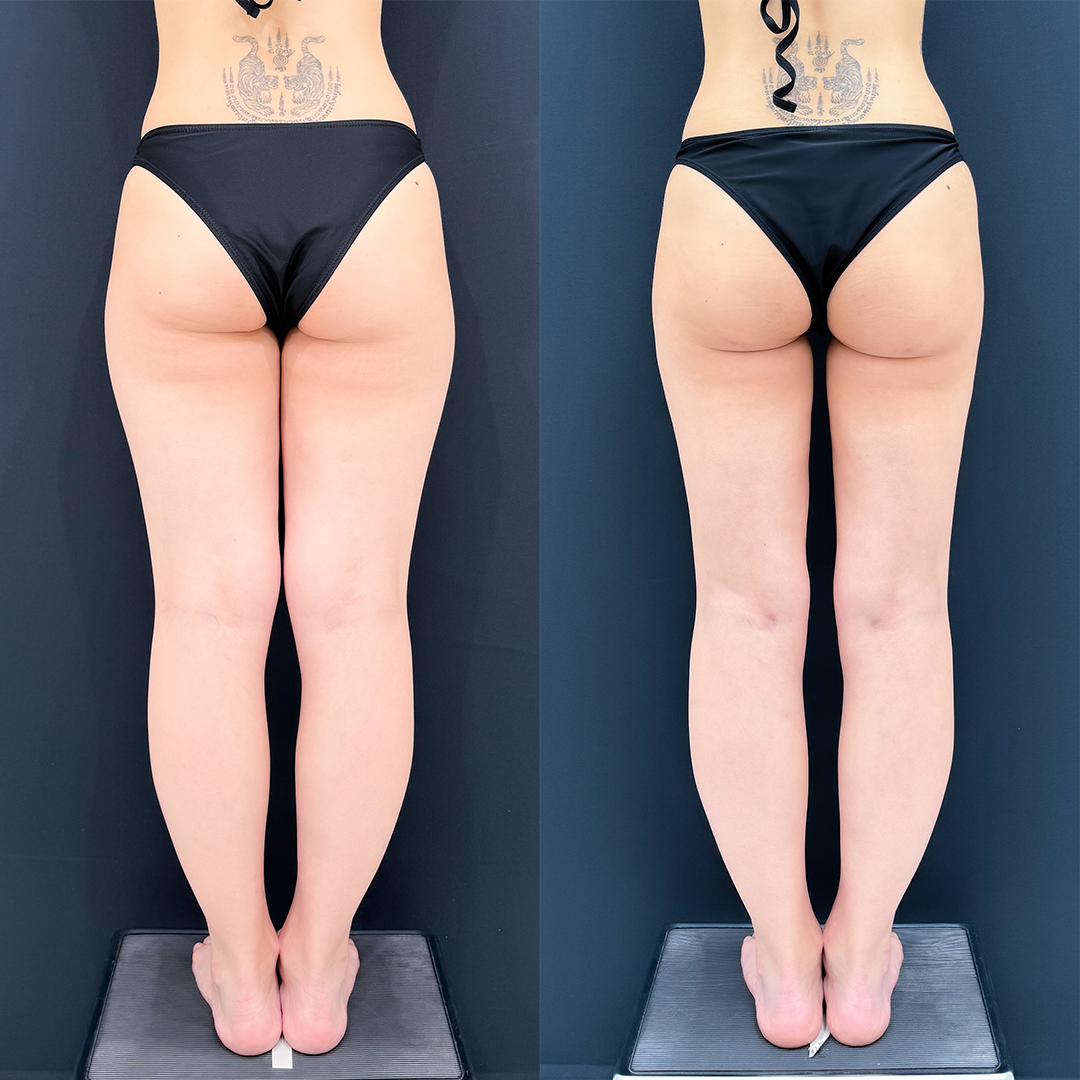 https://purelys-tokyo-clinic.com/wp/wp-content/uploads/2026/03/leg-Liposuction_Case-No.718.jpg