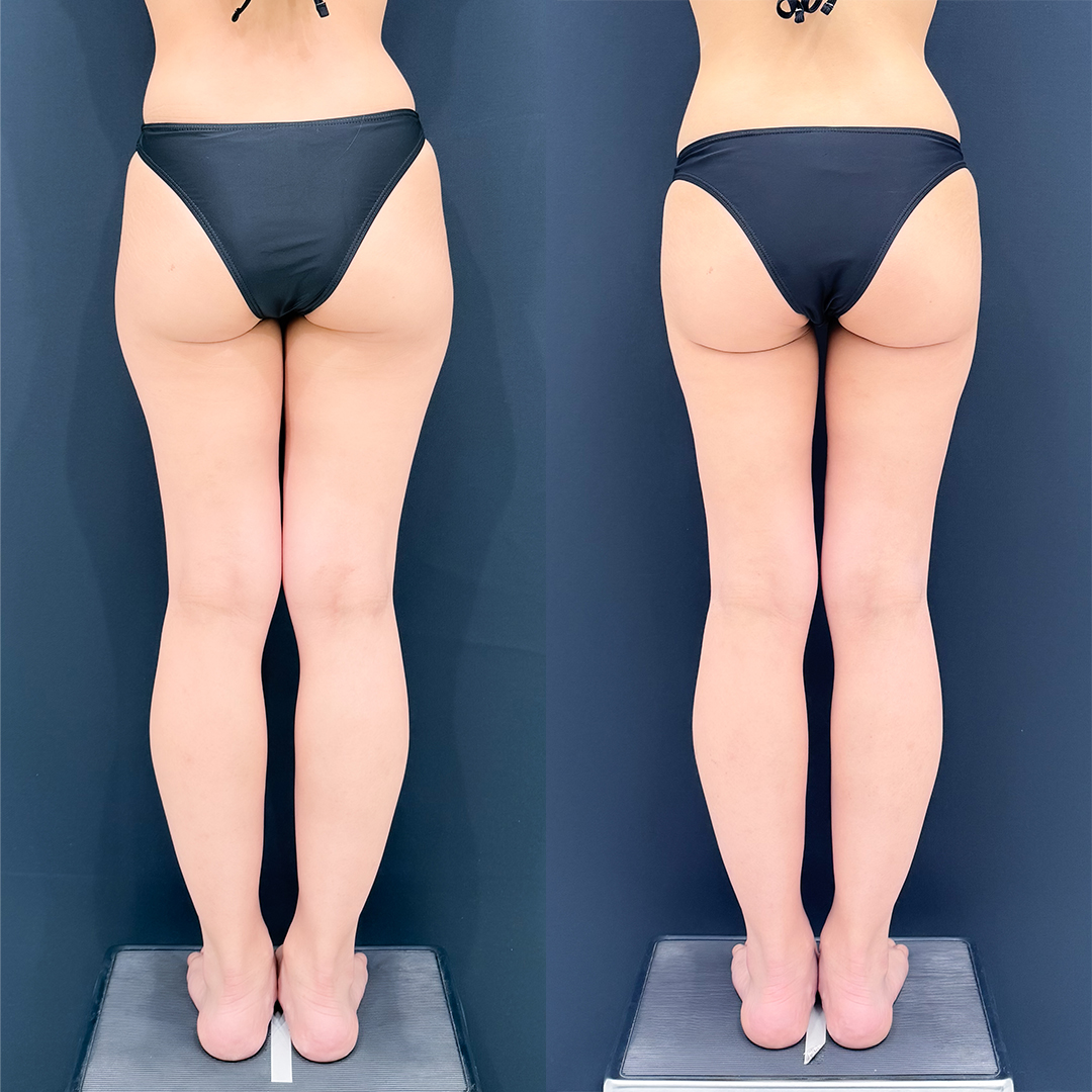 https://purelys-tokyo-clinic.com/wp/wp-content/uploads/2026/03/leg-Liposuction_Case-No.720.jpg