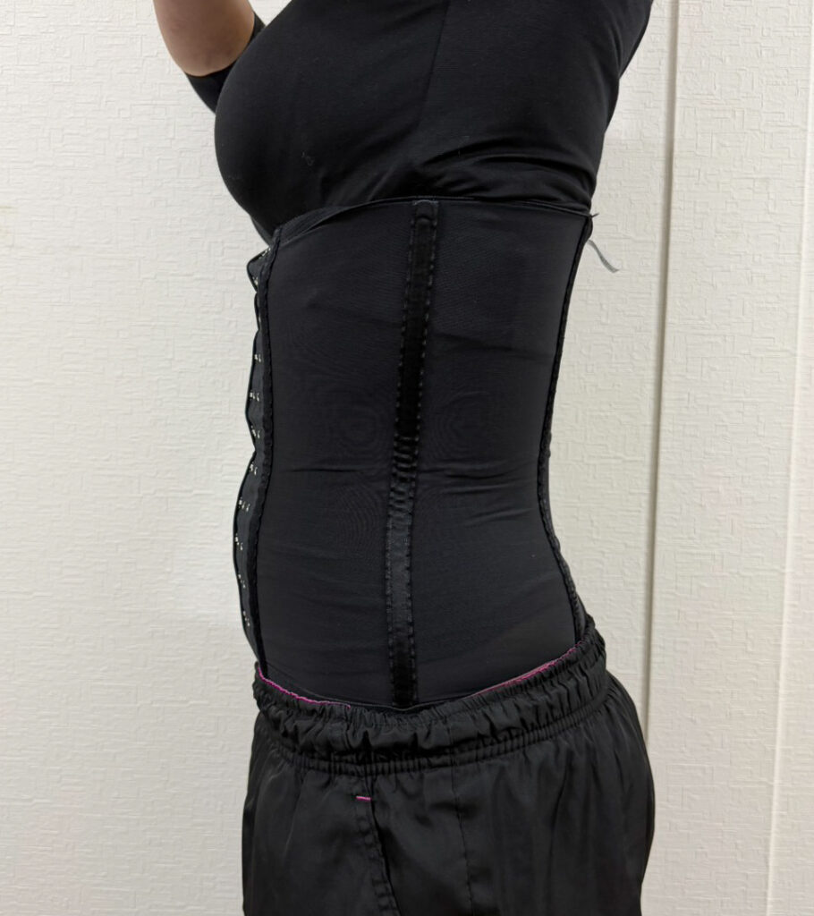 お腹の脂肪吸引