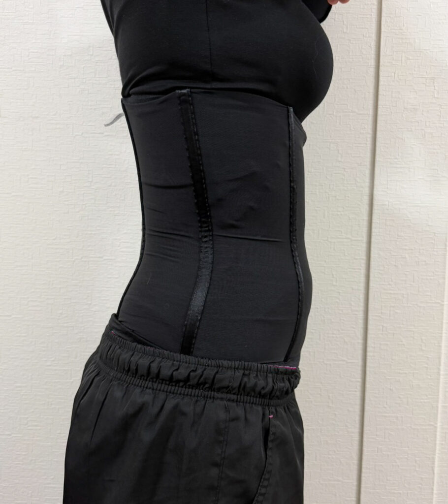 お腹の脂肪吸引