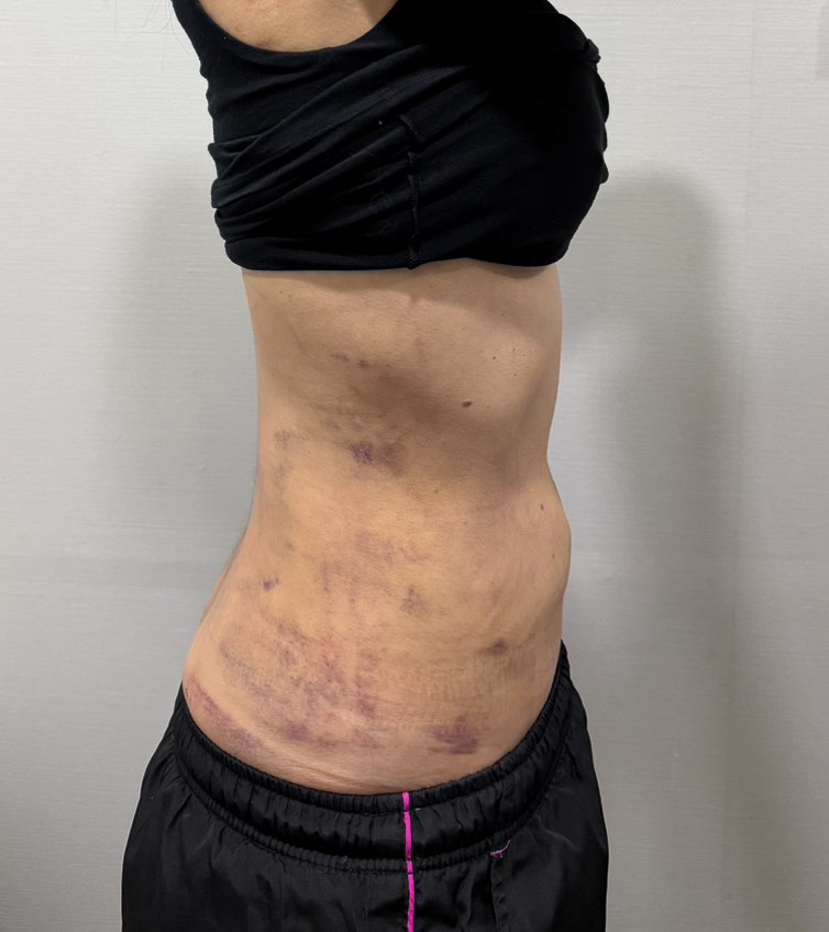 お腹の脂肪吸引