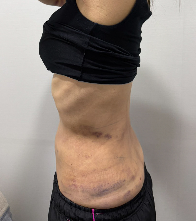 お腹の脂肪吸引