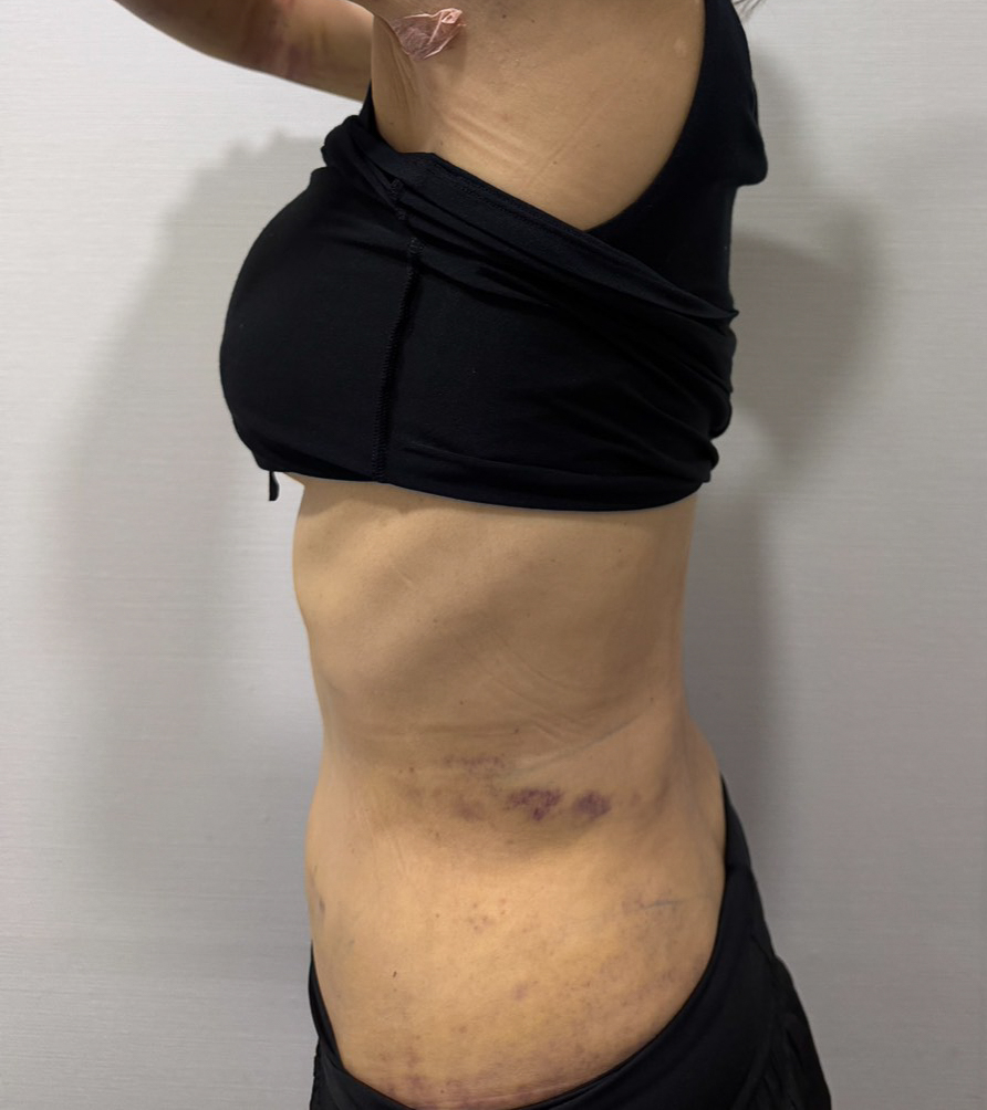 お腹の脂肪吸引