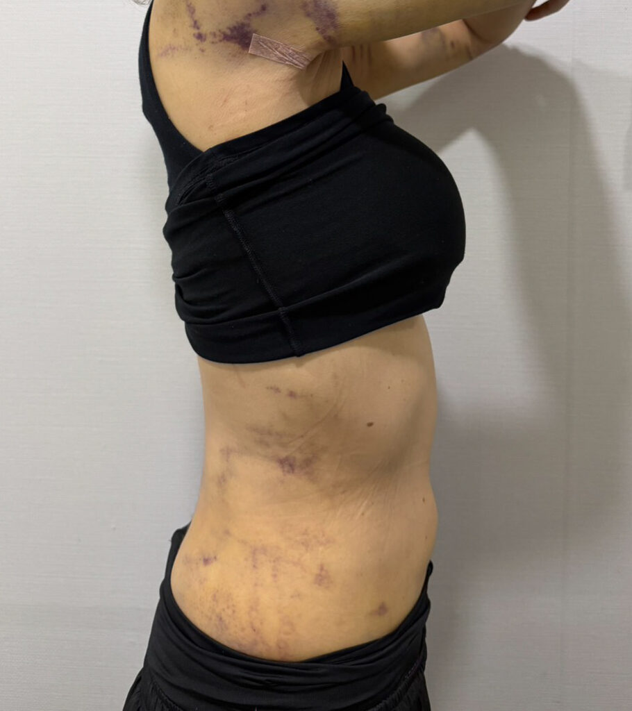 お腹の脂肪吸引