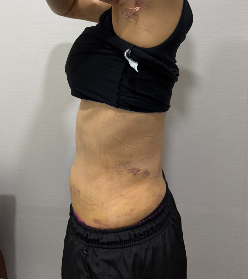 お腹の脂肪吸引