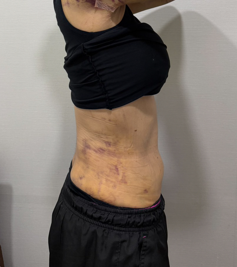 お腹の脂肪吸引