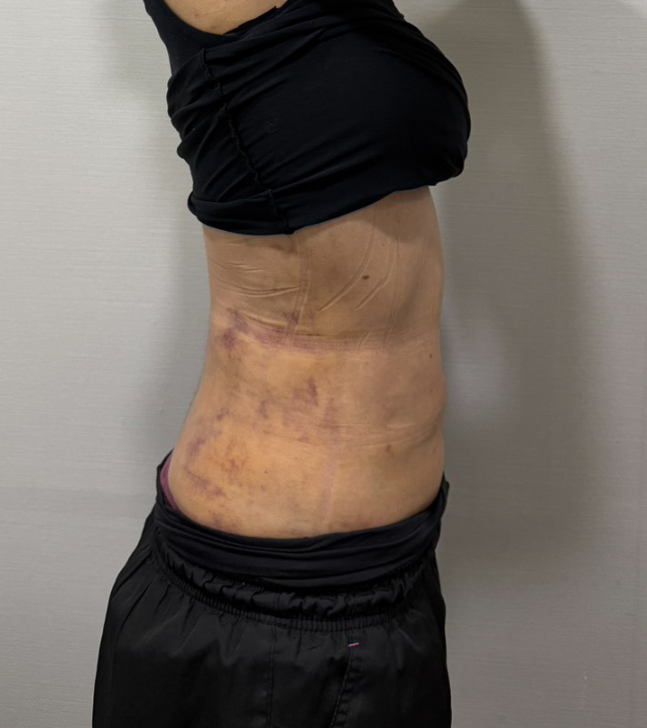 お腹の脂肪吸引