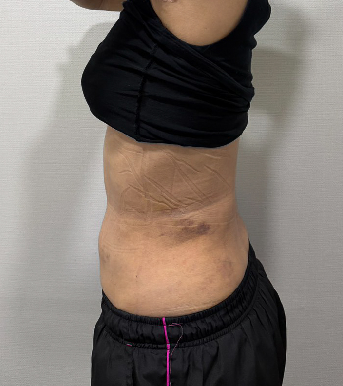 お腹の脂肪吸引