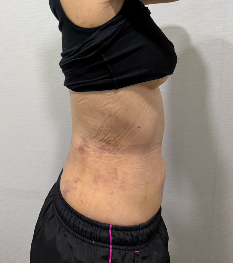 お腹の脂肪吸引