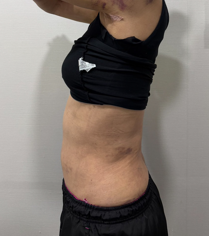 お腹の脂肪吸引