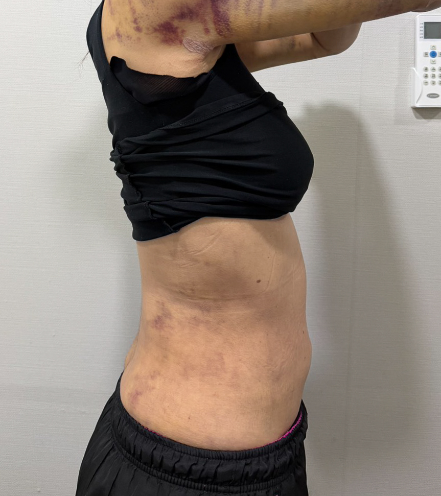 お腹の脂肪吸引