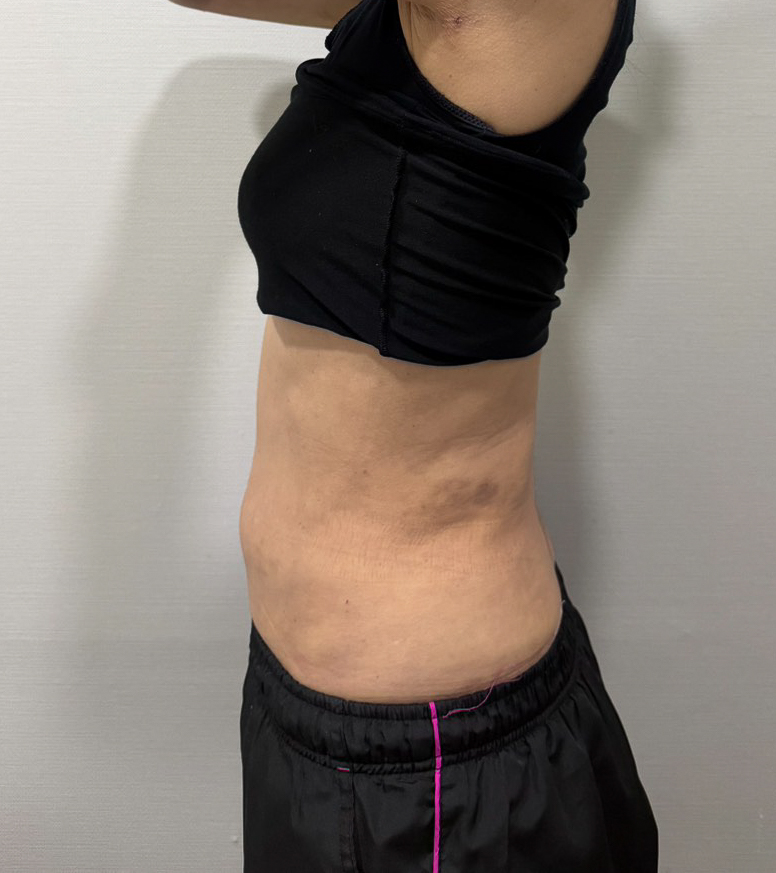 お腹の脂肪吸引