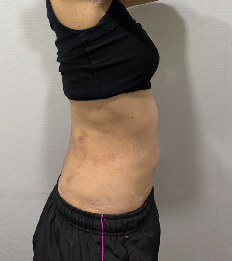 お腹の脂肪吸引