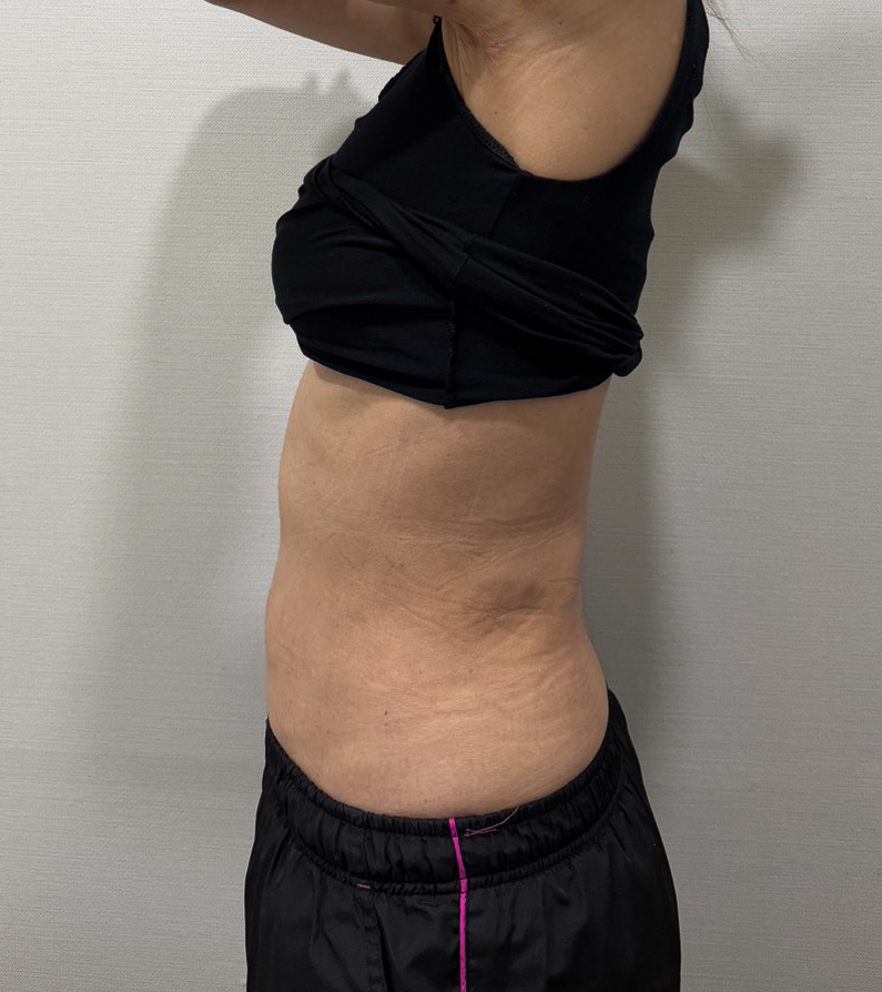 お腹の脂肪吸引