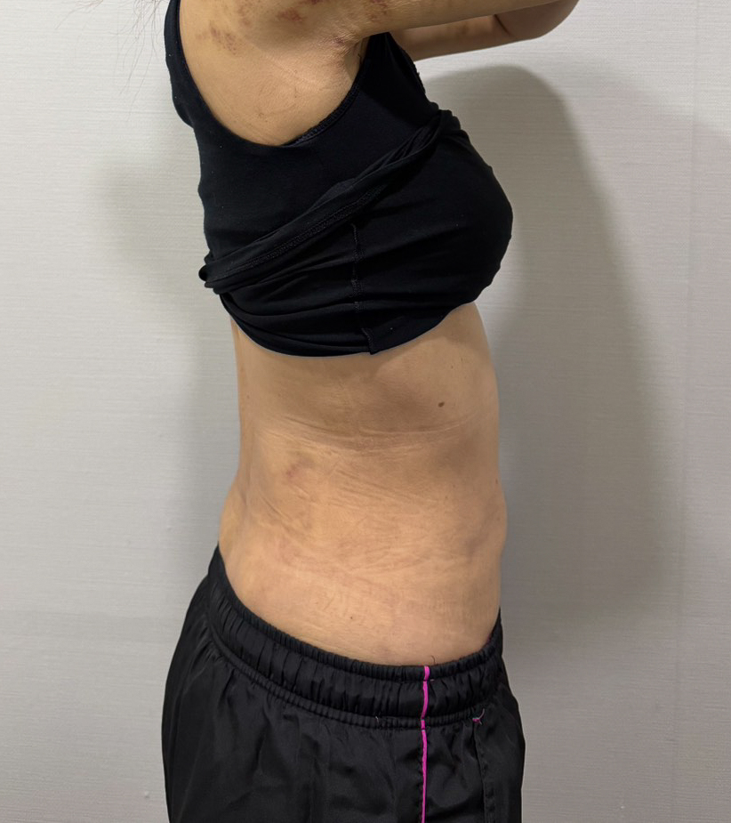 お腹の脂肪吸引