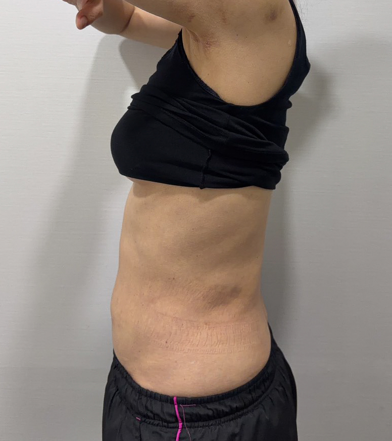 お腹の脂肪吸引