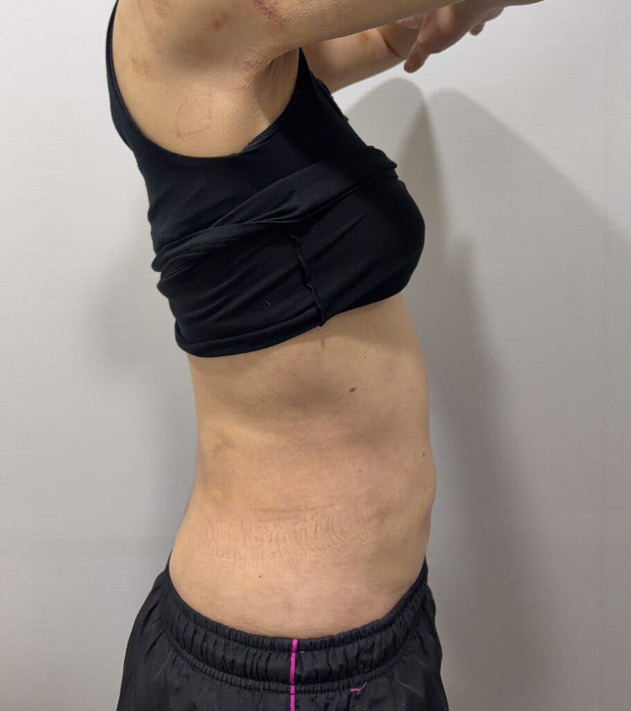 お腹の脂肪吸引