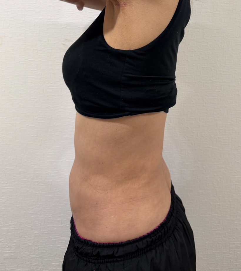 お腹の脂肪吸引