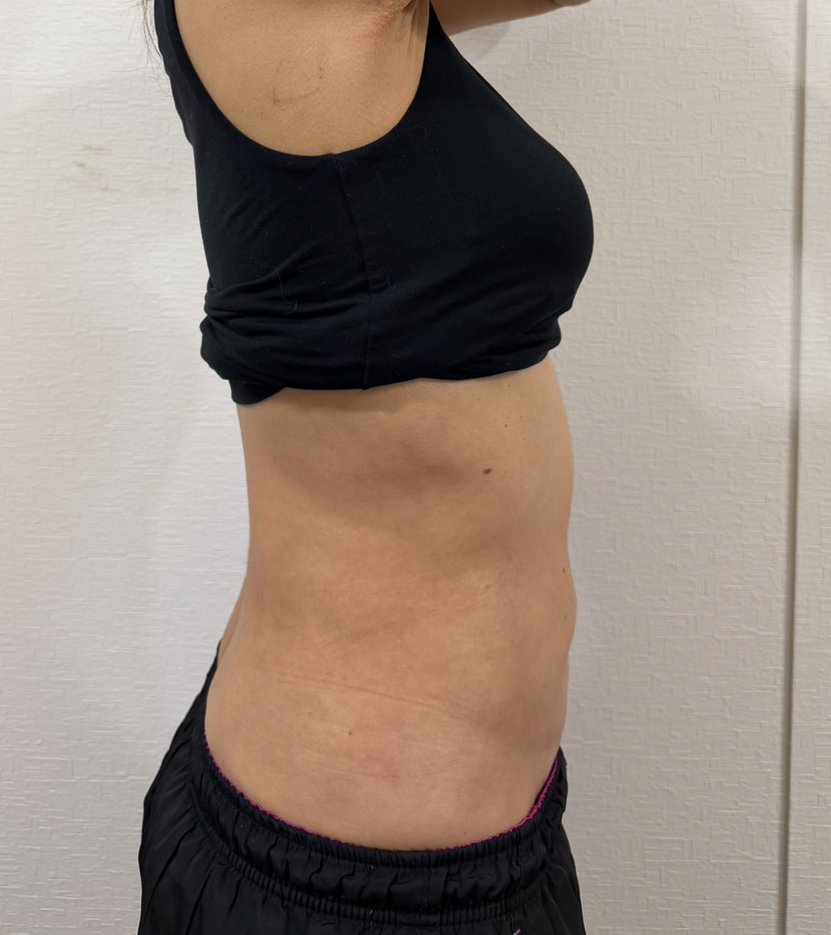 お腹の脂肪吸引