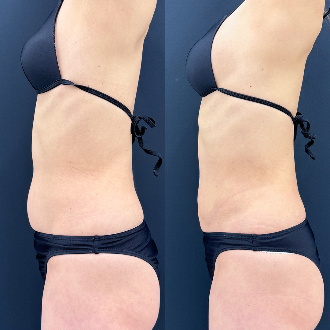 お腹の脂肪吸引