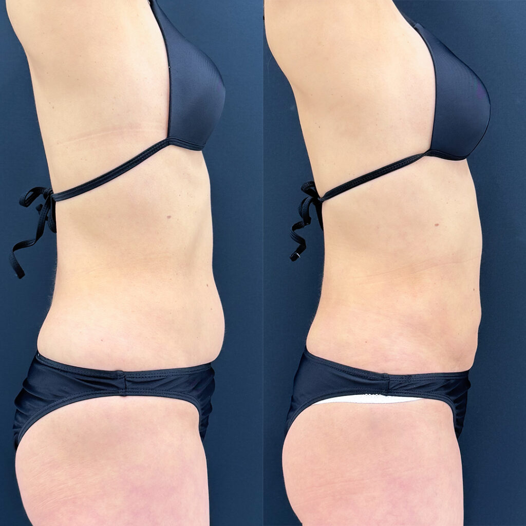 お腹の脂肪吸引