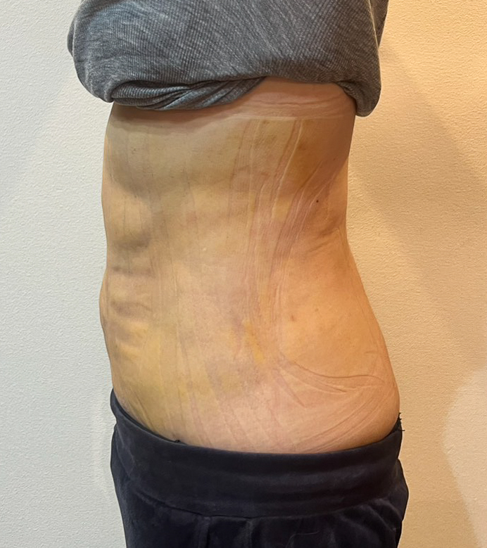 お腹の脂肪吸引