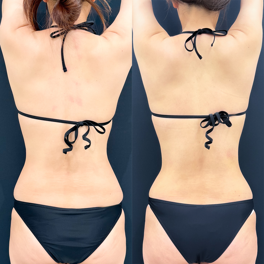 https://purelys-tokyo-clinic.com/wp/wp-content/uploads/2026/04/Before-and-After-abdominal-Liposuction_Case-No.492.jpg