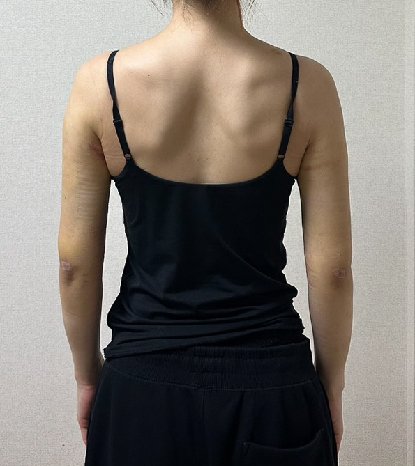 二の腕の脂肪吸引