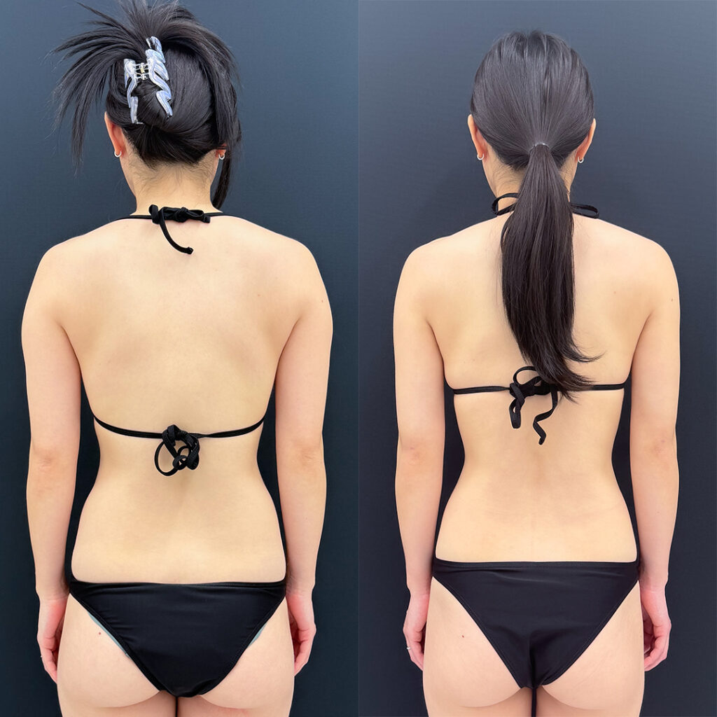 二の腕の脂肪吸引