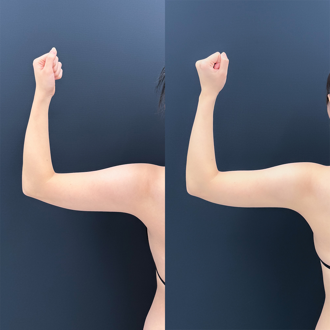 https://purelys-tokyo-clinic.com/wp/wp-content/uploads/2026/04/arm-Liposuction_Case-No.591.jpg