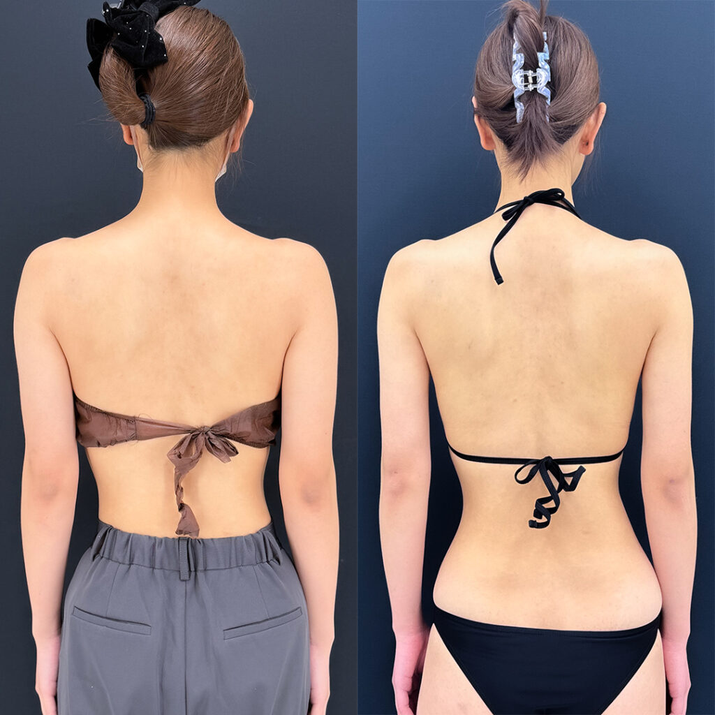 二の腕の脂肪吸引