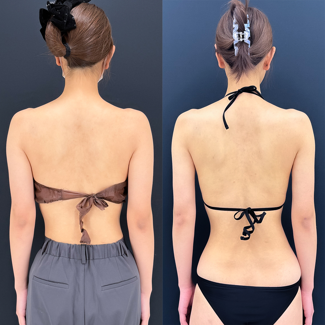 二の腕の脂肪吸引